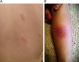 Skeeter syndrom forårsaker ikke langvarige sykdommer eller livsstilsinntrenging når det håndteres riktig. References In Mosquito Allergy Annals Of Allergy Asthma Immunology