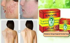 12x MERRY BELL Madame Heng Herbal Soap Original Natural Anti-Acne Face Body  160g