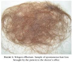 Adverse effects include hypertrichosis (excessive hair growth for age, sex, and race) and irritant or contact dermatitis. Scielo Brasil Clinical And Histological Challenge In The Differential Diagnosis Of Diffuse Alopecia Female Androgenetic Alopecia Telogen Effluvium And Alopecia Areata Part Ii Clinical And Histological Challenge In The