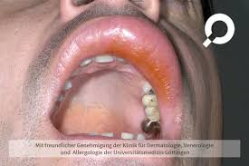 Image result for erysipel photos)