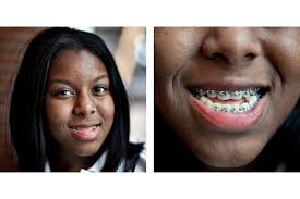 Maybe you would like to learn more about one of these? Braces For Young Kids Might Not Always Be Best Npr