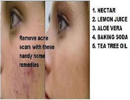 Remove Acne Scars With These Handy Home Remedies By Sonali Medium remove acne scars with these handy home