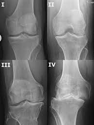 Arthrose Info Kniegelenk Gonarthrose Deutsches Gelenkzentrum