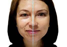 Posee además algunos efectos secundarios como reacciones alérgicas, rigidez facial, náuseas, y entre los efectos realmente no se si todo esto es consecuencia del botox. Efectos Del Botox Positivo O Negativo Joya Life