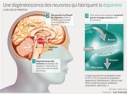 Discover 10 common parkinson's disease symptoms at 10faq health and stay better informed to make healthy living decisions. Toujours Mysterieuse La Maladie De Parkinson Est Mieux Prise En Charge