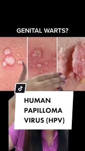 Image result for human papillomavirus symptoms
