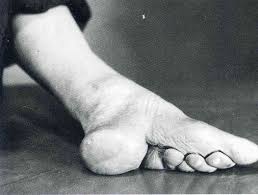 Image result for foot binding