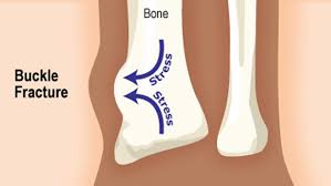 Check spelling or type a new query. Buckle Fracture Causes Symptoms Diagnosis Treatment
