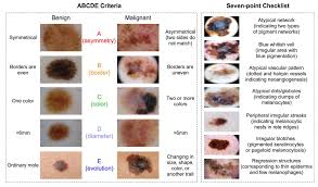 When a doctor performs a skin check, they look at every lump, spot and mole on your entire body; Ijms Free Full Text Melanoma Biomarkers And Their Potential Application For In Vivo Diagnostic Imaging Modalities Html