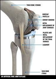 Knee Replacement Surgery Treatment Options Versus Arthritis