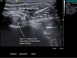 Image result for Biceps Tendon Injection