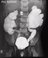 Vesicoureteric Reflux Vur Is The Term For Abnormal Flow Of Urine From The Bladder Into The Upper Urinary Trac Radiology Radiology Imaging Pediatric Radiology