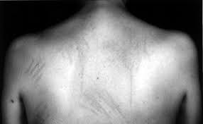 Image result for Dermatographism