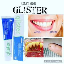 Check spelling or type a new query. Businesswomen Hilangkan Gigi Kuning Dengan Ubat Gigi Glister Ngilu Tau Cuci Gigi Dekat Klinik Semata Buang Plak Atau Kerak Yang Tak Cantik Kat Gigi Ni Kalau Tak Buang Eee Yakkkk Sakit
