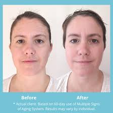 MD Complete Dark Spot Corrector