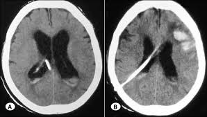 Non Contrast Ct Scan Of Head Showing Evd In Situ A Followed By Right Download Scientific Diagram