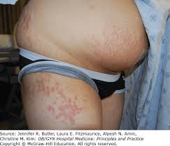 Image result for pruritic urticarial papules and plaques of pregnancy