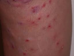 How serious are red bumps on the skin? Folliculitis Dermnet Nz