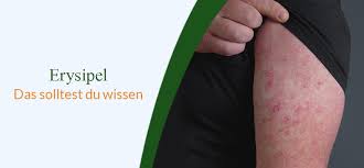 Image result for erysipel photos)