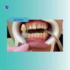 Odonto Implantes (@odontoimplantes_) • Instagram photos and videos