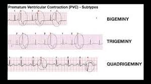 Pvcs may be unifocal (see above), multifocal (see below) or finally a pvc may retrogradely capture the atrium, reset the sinus node, and be followed by an under these circumstances atrial contractions may occur when the tricuspid valve is still closed. Ekg Patterns Premature Atrial Ventricular Contractions Pacs Pvcs Youtube