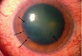 Noninfectious keratitis can be caused by a relatively minor injury, by wearing your contact lenses basics of hsv (herpes simplex virus) keratitis. Bullous Keratopathy Eye Disorders Merck Manuals Professional Edition