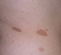 The three types are neurofibromatosis type i (nf1), neurofibromatosis type ii (nf2), and schwannomatosis. Neurofibromatosis American Association For Pediatric Ophthalmology And Strabismus