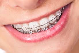 They tend to be slightly more expensive than standard braces. Benefits Of Clear Braces Frankford Dental Care Philadelphia Pennsylvania