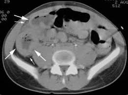 Image result for Neutropenic Colitis