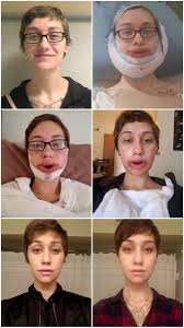 My Journey From Pre Double Jaw Surgery To 4 Weeks Post Surgery Plus A Haircut Jaw Surgery Double Jaw Surgery Beauty Skin