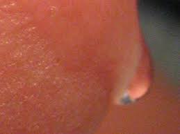 Hiv Infektion Hautausschlag Cyberdoktor Patientenberatung