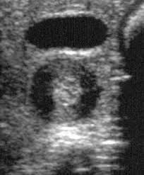 Ultrasound is not different from normal (audible) sound in its physical properties, except that humans cannot hear it. Pyloric Stenosis Pediatrics Medbullets Step 2 3