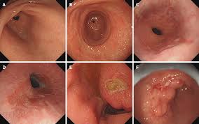 Clinically significant endoscopic findings in patients of dyspepsia with no warning symptoms: A cross-sectional study Indigestion | Causes | Diagnosis | Treatment | Best | Homeopathic | Gastroenterologist | in | Pakistan | Homeopathic | Best Homeopathic Doctor in Pakistan | Dr Qaisar Ahmed MD, DHMS