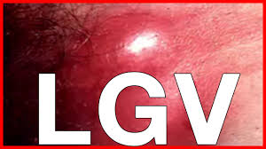 Image result for lymphogranuloma venereum