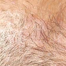 When your hair follicles are dead, they do not regrow hair. How To Know If Hair Follicles Are Dead Or Alive Ahs India