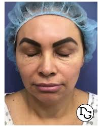 8 weeks post blepharoplasty ✨😍, Your eyes are your most prominent feature  — let them shine! If you have sagging, drooping, or wrinkled skin around  your eyes that makes you feel less confident, a ...