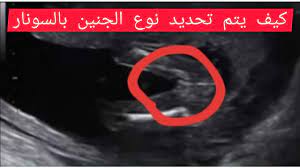 سونار لجنين انثي في الشهر الخامس وكيف يتم تحديد نوع الجنين بالسونار youtube
