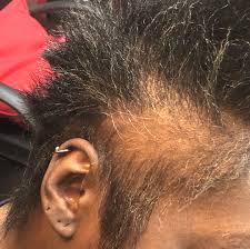 Dec 31, 2020 · as for direction, maintain a consistent pattern of up and down, side to side, and even diagonal. Using A Dermaroller For Treating Hair Loss Mdhairmixtress Com