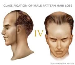 Good haircuts for men latest 2016 ellecrafts. Classification Of Male Pattern Hair Loss Ilht Dubai