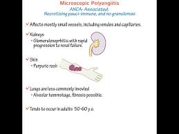 Image result for Microscopic Polyangiitis
