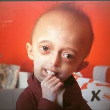 Image result for progeria case in bihar