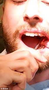 A cold, damp washcloth or a gauze piece can be used to grip the tooth and turn it to pull it out quickly. Dentistry Student Jesper Ryltoft Pulls Out His Own Wisdom Tooth On Quiet Day At Work Daily Mail Online
