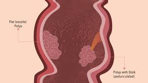 Types Of Colon Polyps Colon Polyp Symptoms And Risk Factors