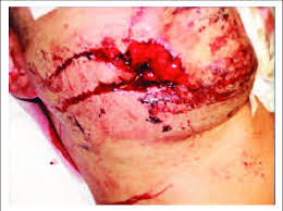 Filkins, md, jd, phd context.—gunshot wounds are the most common cause of homicidal death in the united states. This Uk Soldier Presented With A Gunshot Wound In The Back Of The Neck Download Scientific Diagram