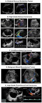 Ovarian cysts occur commonly in women of all ages. Diagnostics Free Full Text Ultrasound Monitoring Of Extant Adnexal Masses In The Era Of Type 1 And Type 2 Ovarian Cancers Lessons Learned From Ovarian Cancer Screening Trials Html