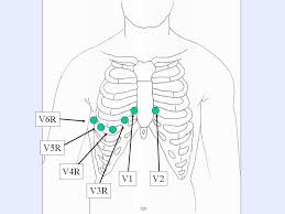 12 Lead Ecg Lead Placement Diagrams Ems 12 Lead