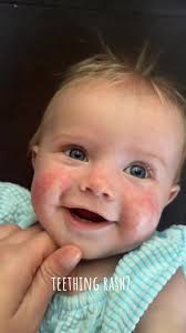 Bby Teething Red Face