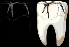 Image result for Tooth Fracture