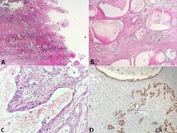 The tumor cells are moderately differentiated. Metastatic Gallbladder Carcinoma Presenting As An Ovarian Mass