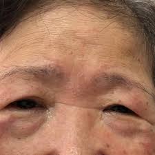 Paralisia do Olhar Vertical em paciente com Paralisia Supranuclear  Progressiva | A paralisia supranuclear progressiva (PSP) é considerada a  causa mais comum de parkinsonismo de caráter degenerativo após a DP. A forma